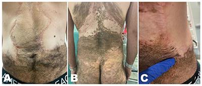 Case report: Later onset of NRAS-mutant metastatic melanoma in a patient with a partially-excised giant congenital melanocytic nevus